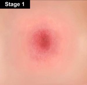 Where can you find pictures of the stages of bed sores?