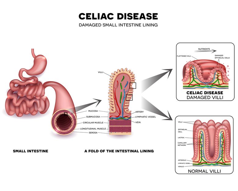 A new study from the Mayo Clinic calls for screening of all first-degree relatives of celiac-disease patients.