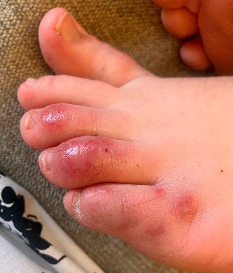 ‘covid Toes Other Rashes Latest Possible Rare Virus Signs The